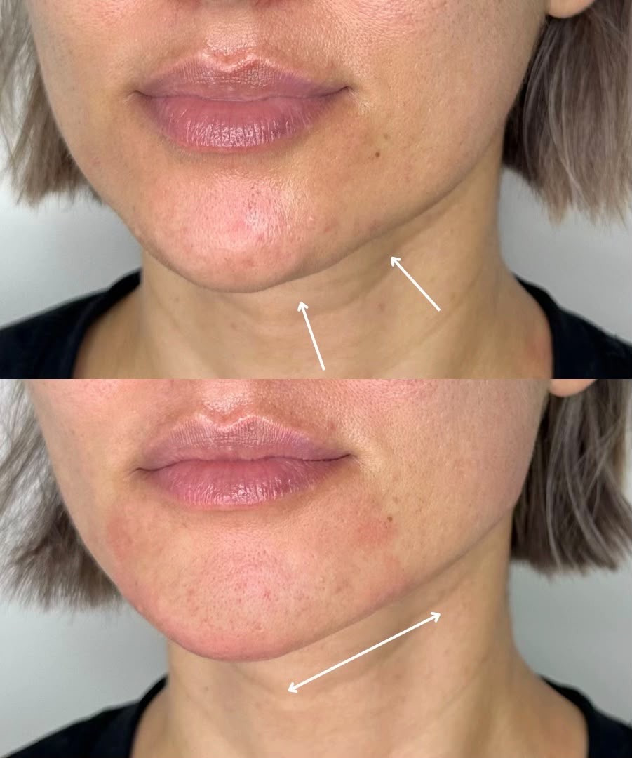 Jaw contouring result
